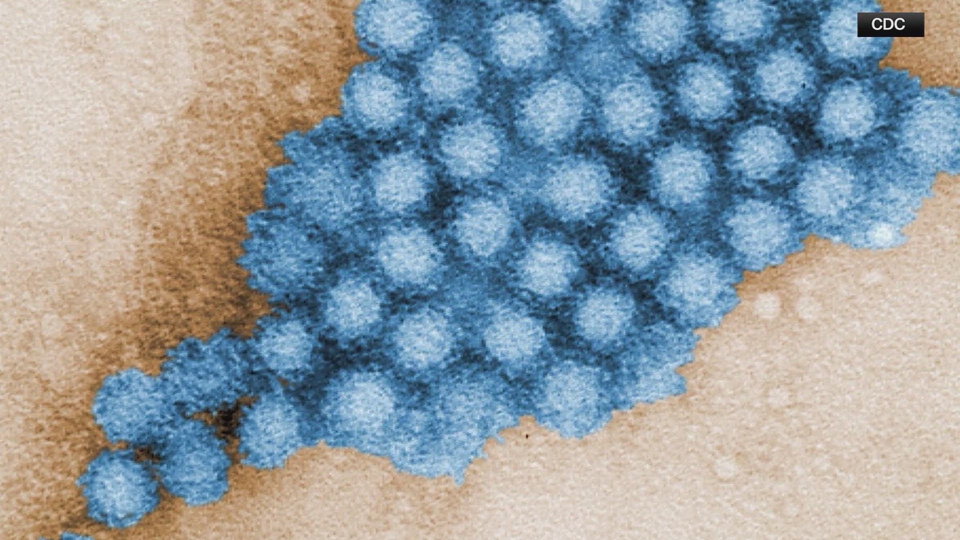 Stomach bug symptoms to know as norovirus cases surge in parts of the U