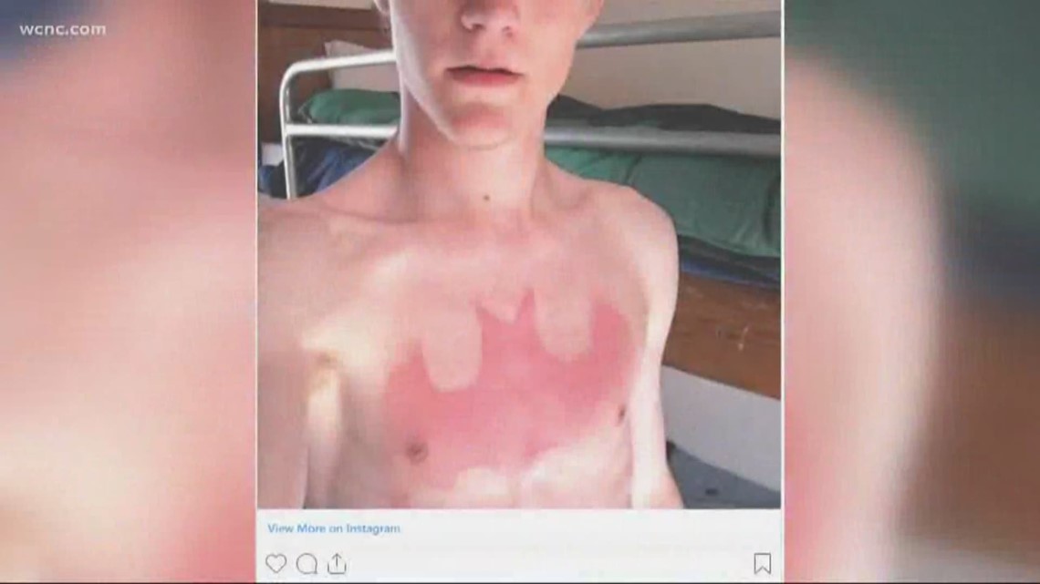 So-called "sunburn tattoos" are all over social media right now. People are putting stencils or stickers on their skin, then laying-out in the sun without sunscreen.