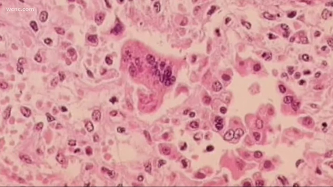 Two new measles cases confirmed in North Carolina