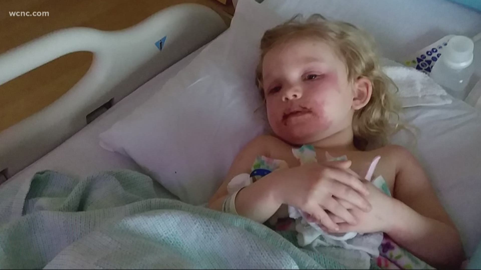 A family says their 3-year-old daughter suffered a severe allergic reaction to a child's makeup kit.