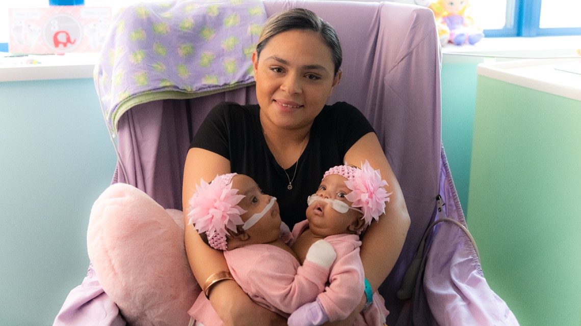 Formerly conjoined twins celebrate one year post-op - Vimarsana News