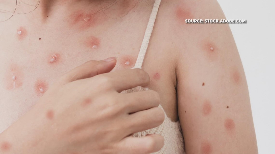 Monkeypox case confirmed in Randolph County - Vimarsana News