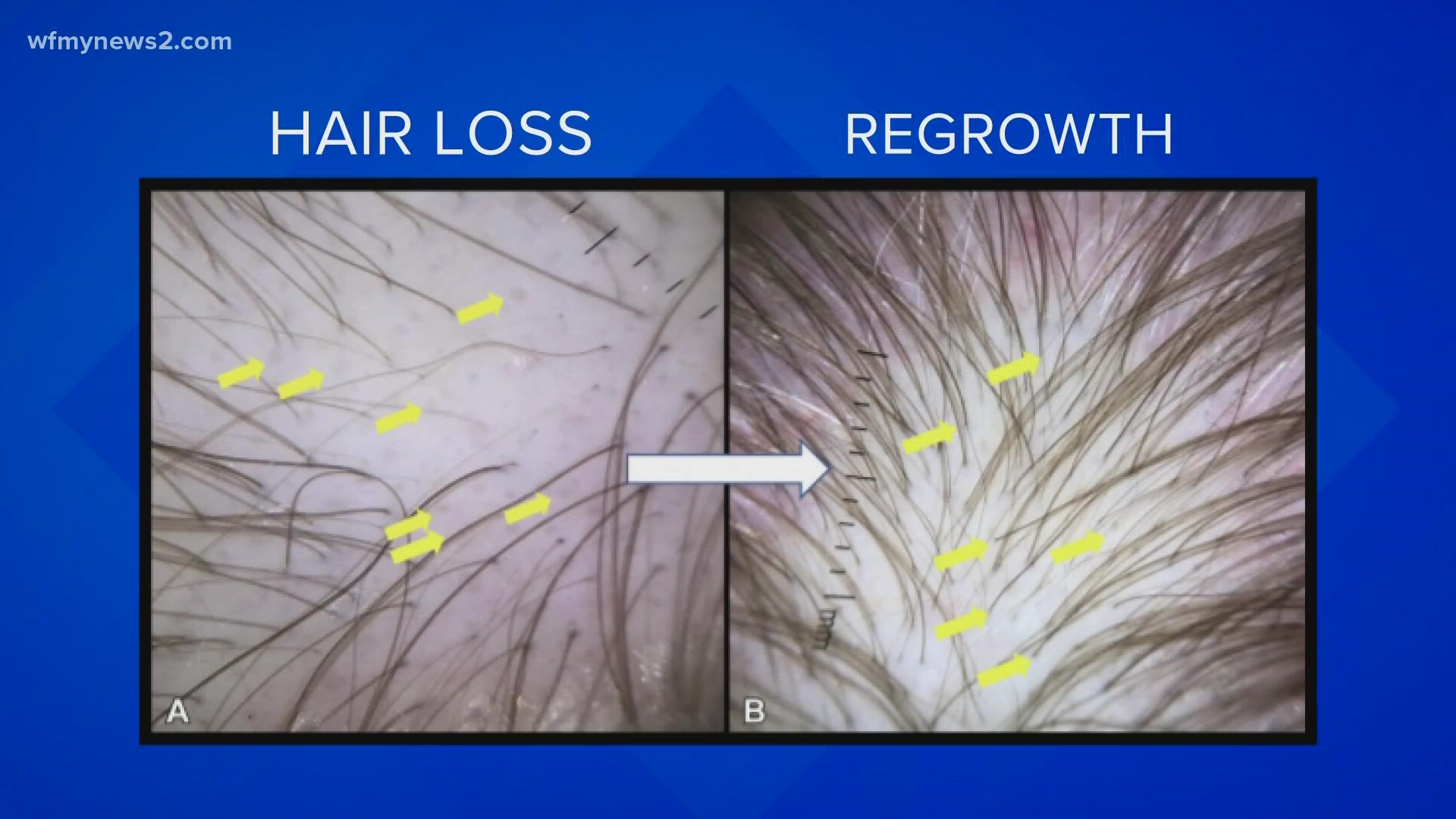 Research shows more than two-thirds of people hospitalized with COVID-19 have at least one lingering symptom like hair loss.