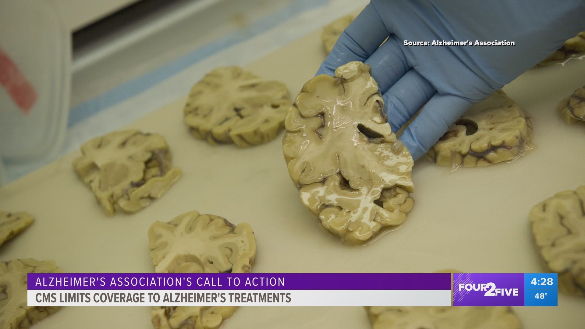 The Alzheimer's Association is speaking out after Medicare proposed to limit coverage of a new drug approved by the F-D-A to help Alzheimer's patients.