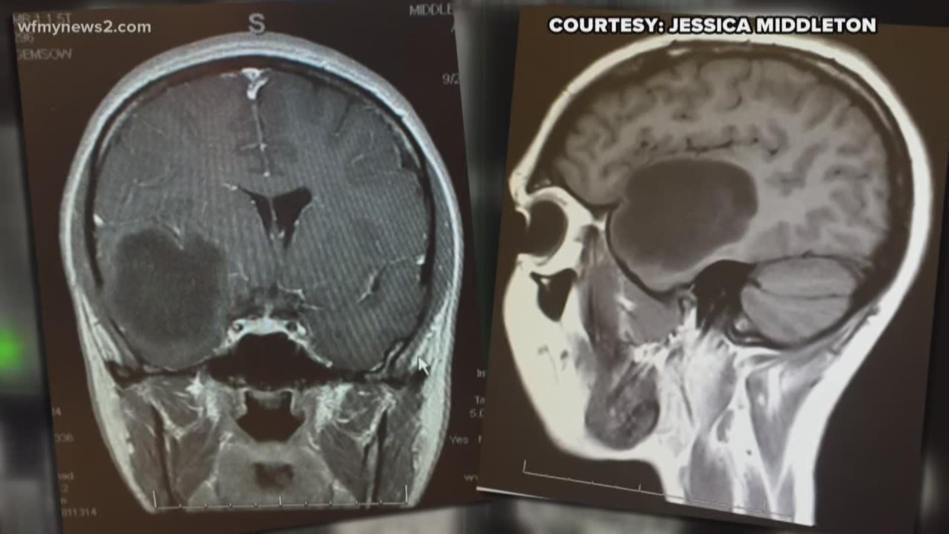 Jessica Middleton was 25 when she was diagnosed with brain cancer. The scan showed a fist-sized tumor in her brain and doctors at Cone Health immediately diagnosed it as an advanced grade stage four cancer.