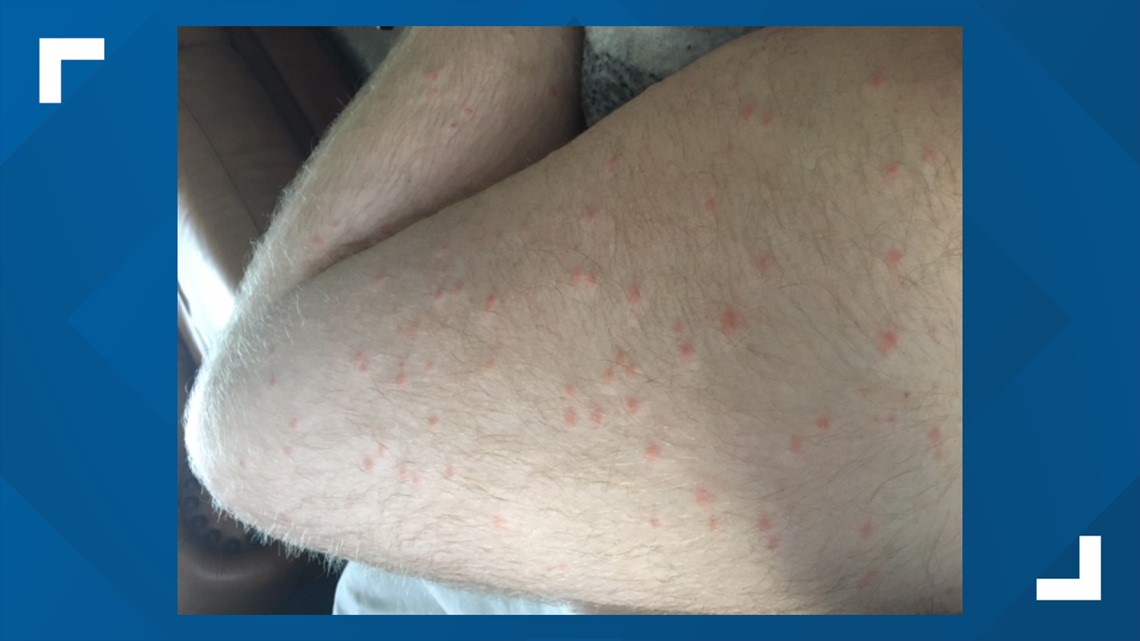 Seed ticks cover NC man during fishing trip | wfmynews2.com