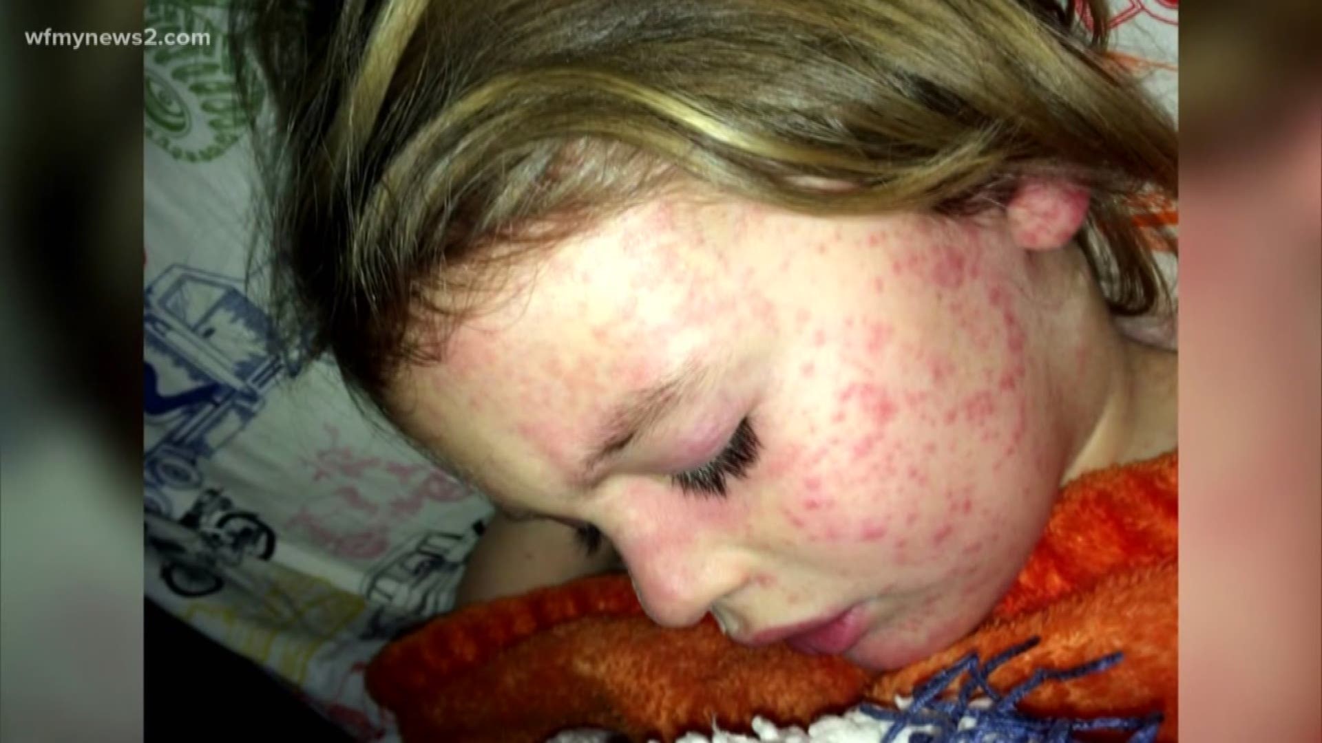 The CDC says measles cases have it a high in the U.S. after it declared the disease eliminated almost, in 2000.