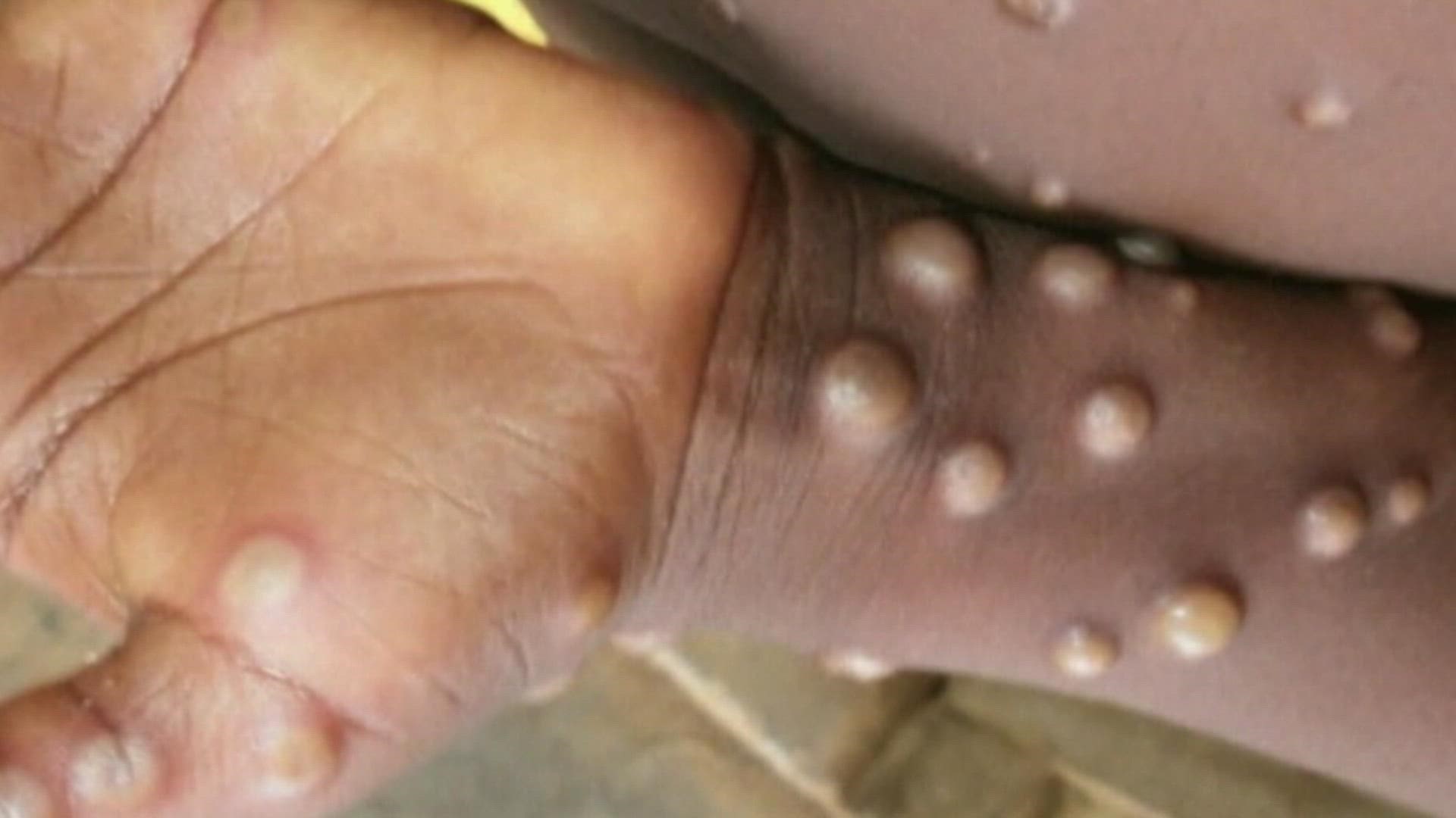 Experts discussed who is eligible for a monkeypox test and who is eligible for a vaccine.