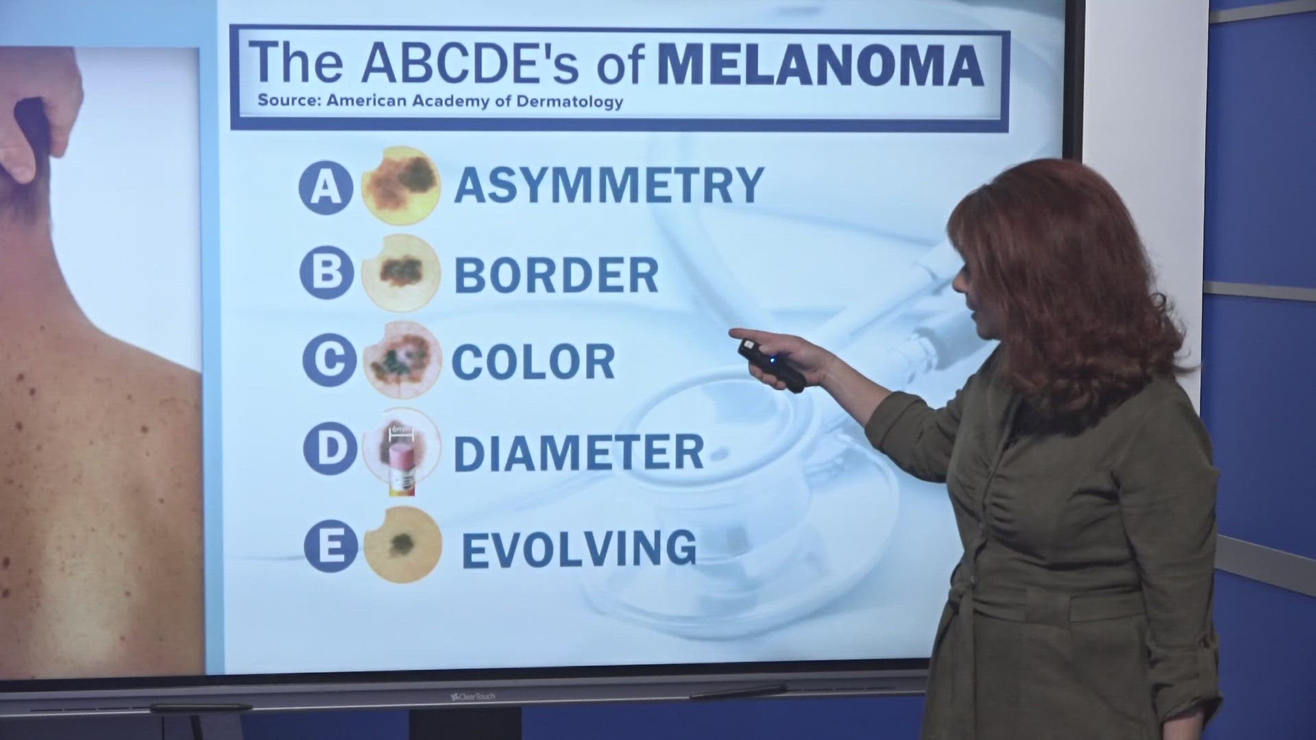 After the Duchess of York is diagnosed with melanoma, you should look for these signs to see if you have skin cancer.