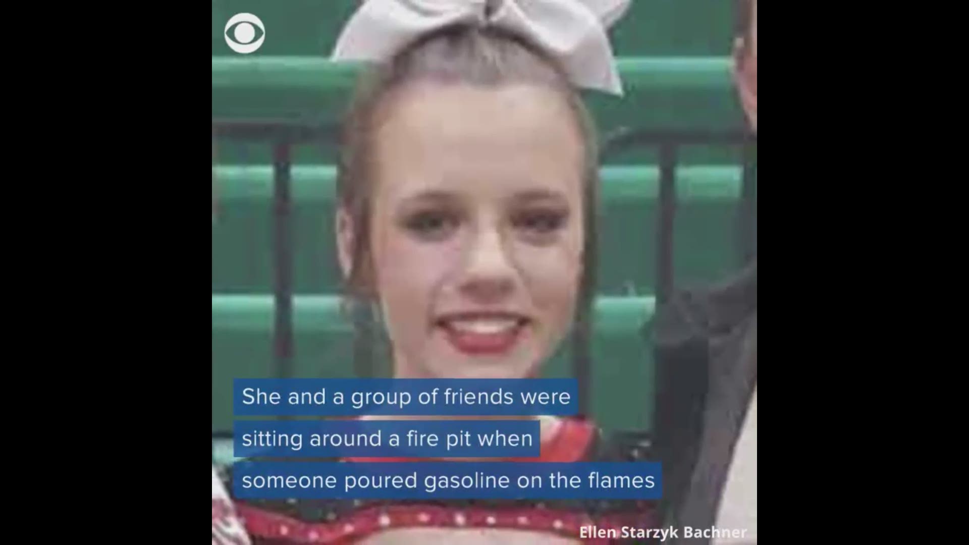 A 15-year-old girl severely burned by a backyard fire pit thought she was going to miss her high school prom. But then her date and her friends brought the prom to her.