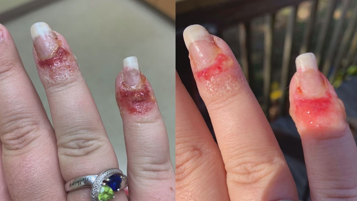 Woman Claims Trip to Nail Salon Left Her With a Fungal Infection |  
