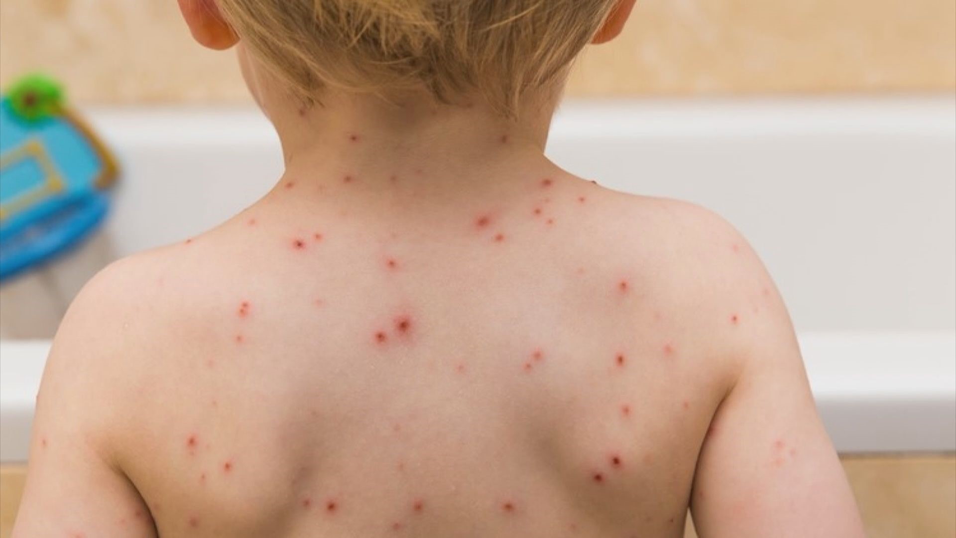 A viral post claims Head and Shoulders shampoo soothes chicken pox irritation. A doctor says it’s true.
