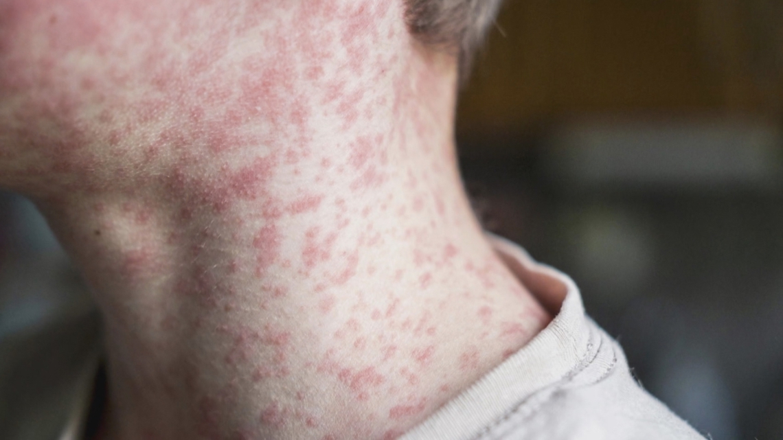 Health officials warn of possible measles exposure at RDU airport