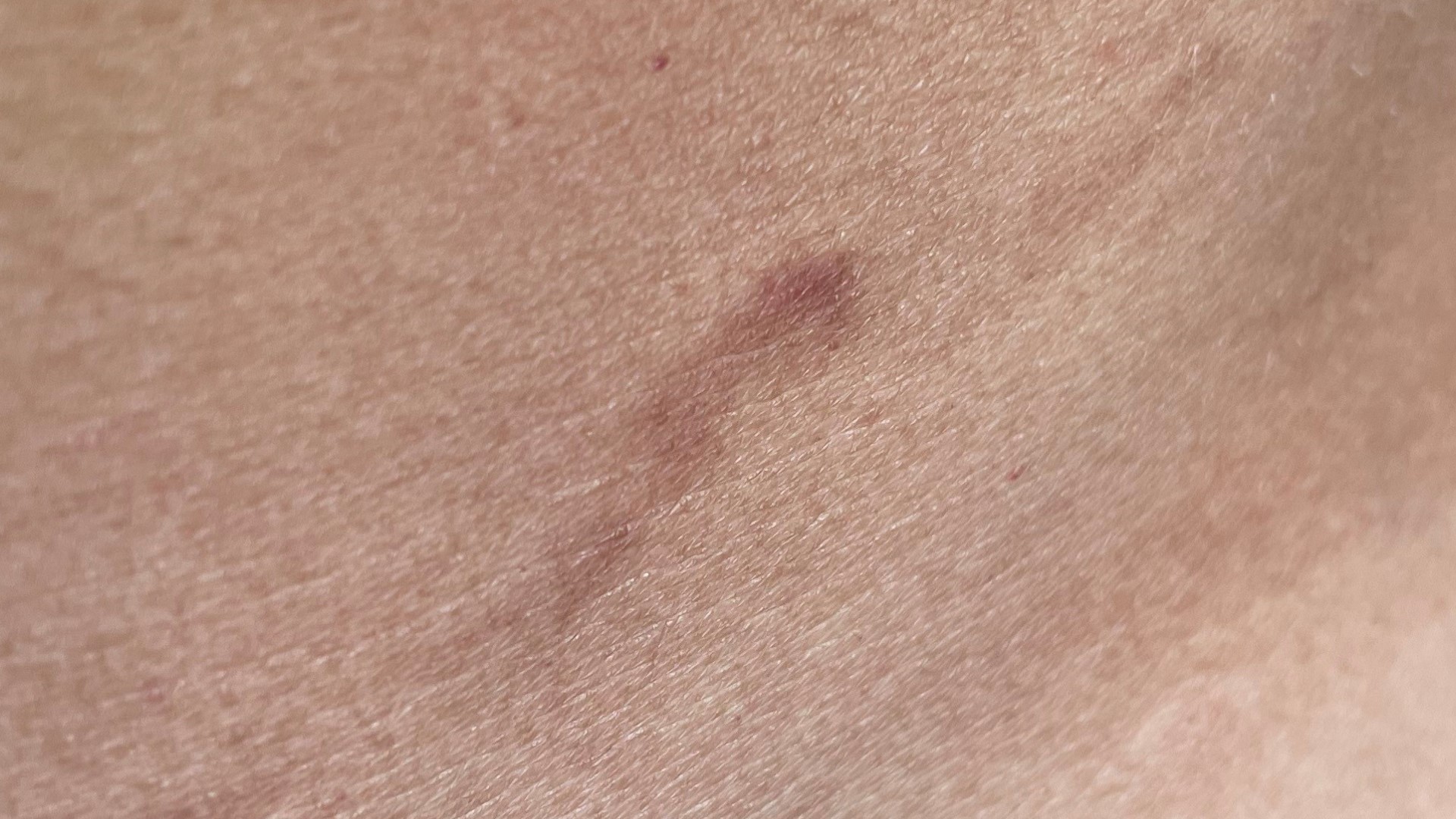 Margarita Burn is a real condition