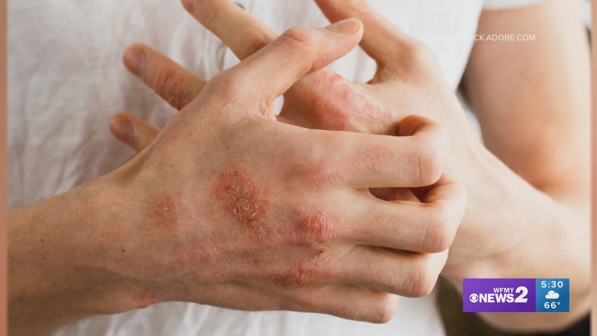 Eczema can be caused by several things including stress. What you eat plays a role in treating it.