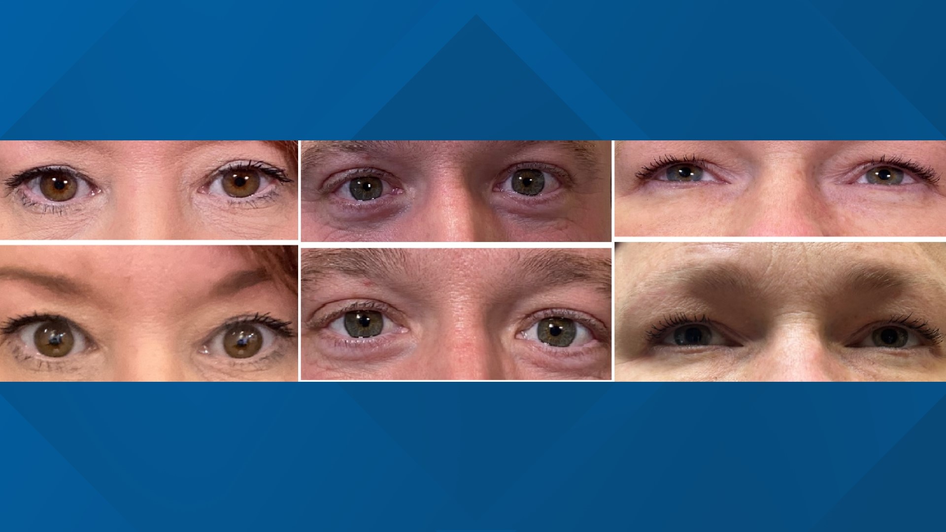 Get an eye lift without surgery Upneeq before and after