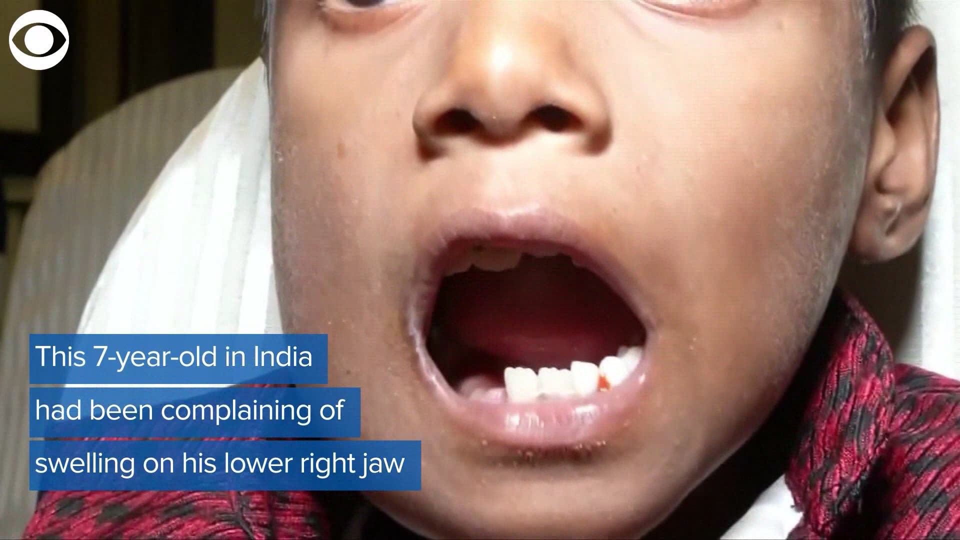 A young boy in India had been complaining of jaw pain for years and an X-ray of his mouth revealed the shocking reason why.