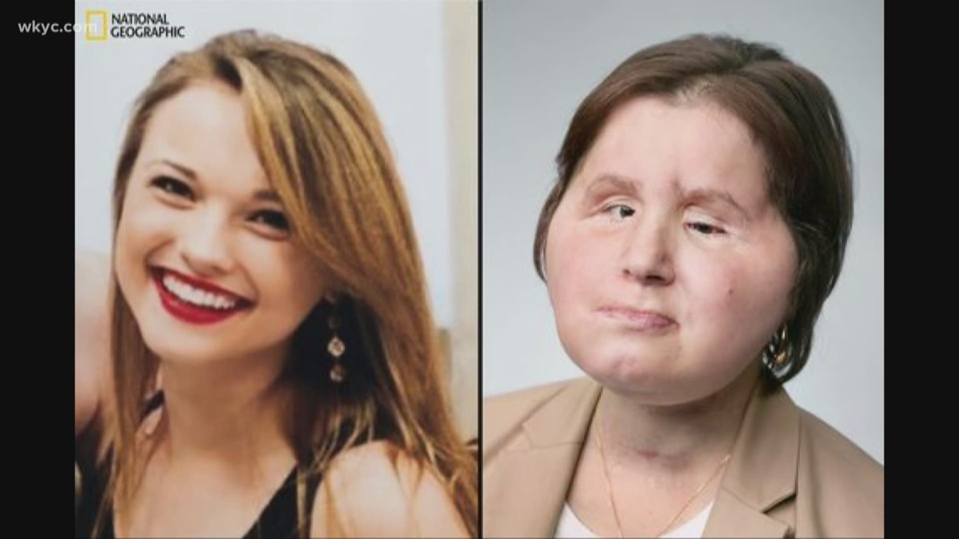 The science behind the youngest face transplant 