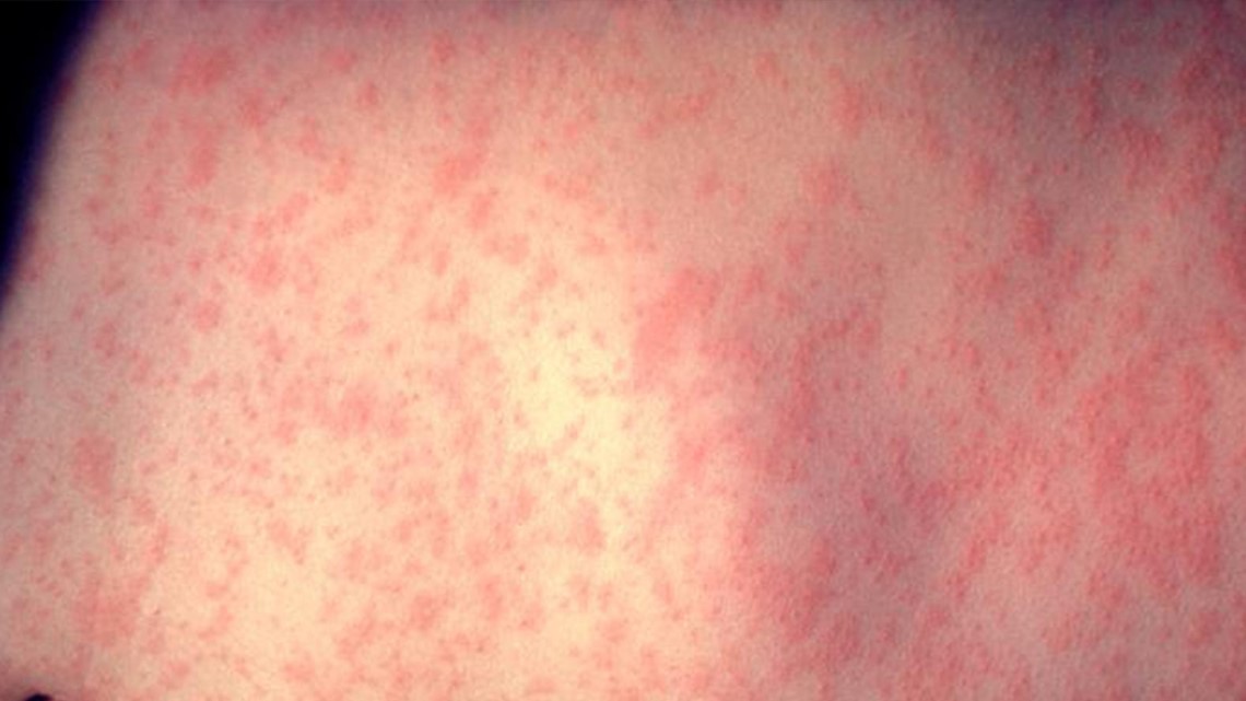 Adult tests negative for suspected measles case in Guilford Co. - Vimarsana News