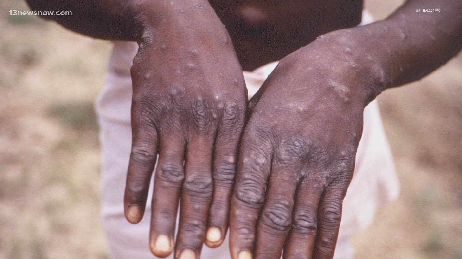 So far, there are no reported cases of monkeypox in Virginia.