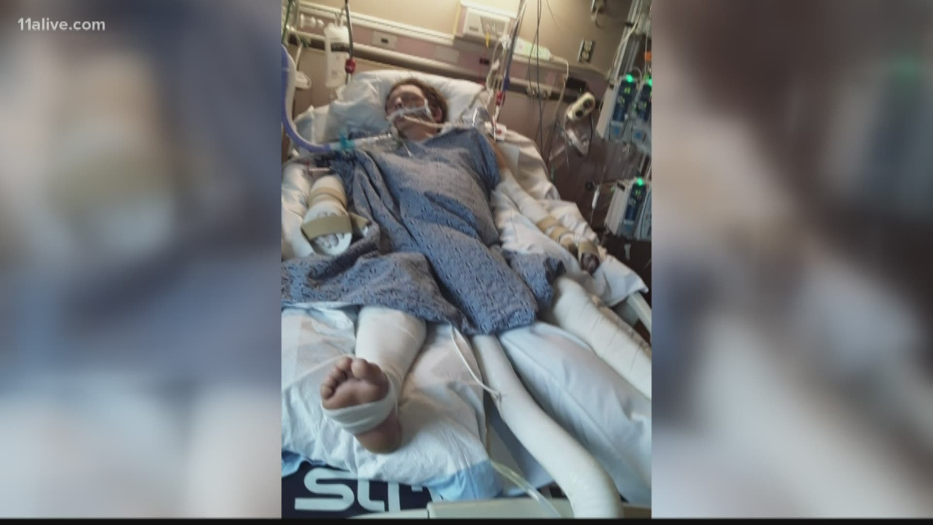 A terrifying work accident left a Milton man with burns on 60 percent of his body last week.